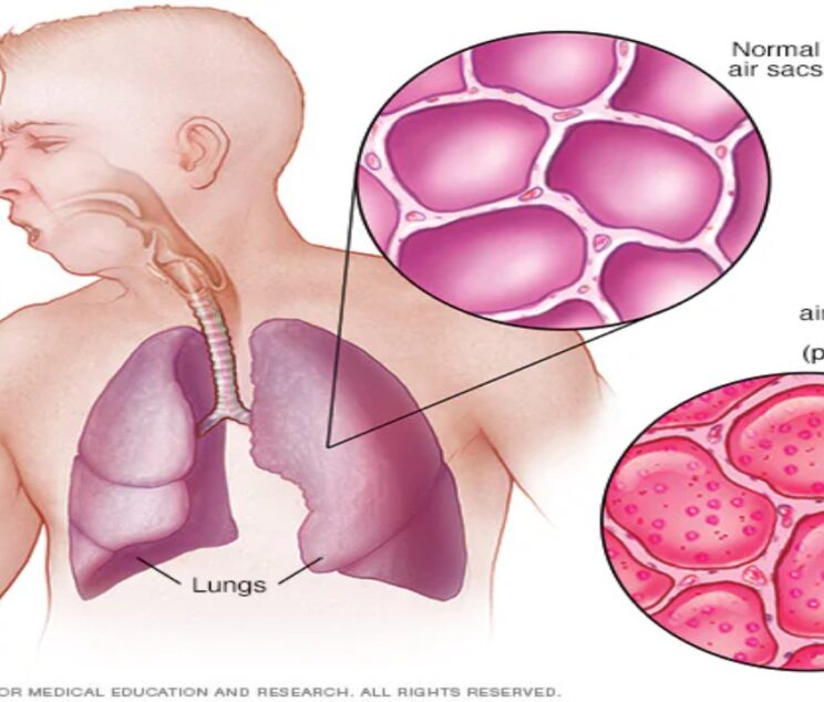 pneumonia symptoms