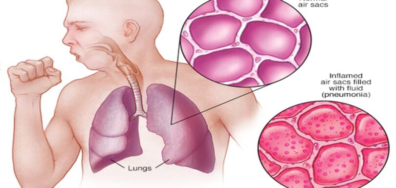 pneumonia symptoms